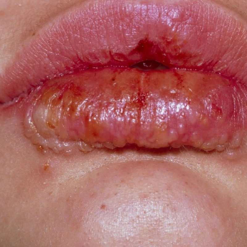 تزریق ژل لب در مشهد | قبل از اینکه تصمیم بگیری، اینو بخون!